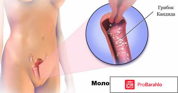 Молочница у женщин симптомы лечение препараты отзывы обман