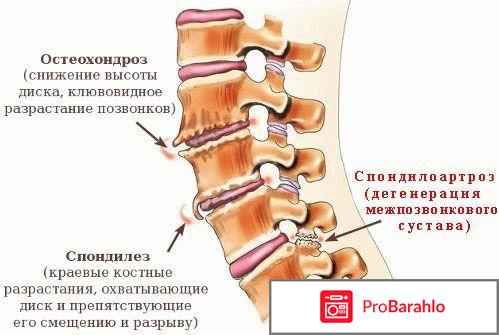 Фасеточный синдром отрицательные отзывы