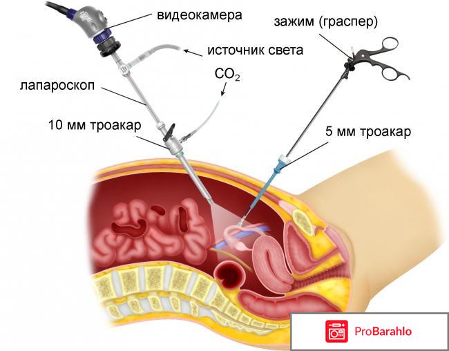 Лапароскопия труб 