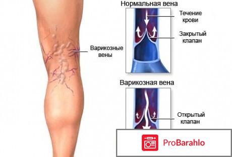 38 Fule Vasculitis - пластырь от варикоза: купить по отрицательные отзывы