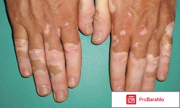 Витилиго лечение 2017 лекарство отзывы 