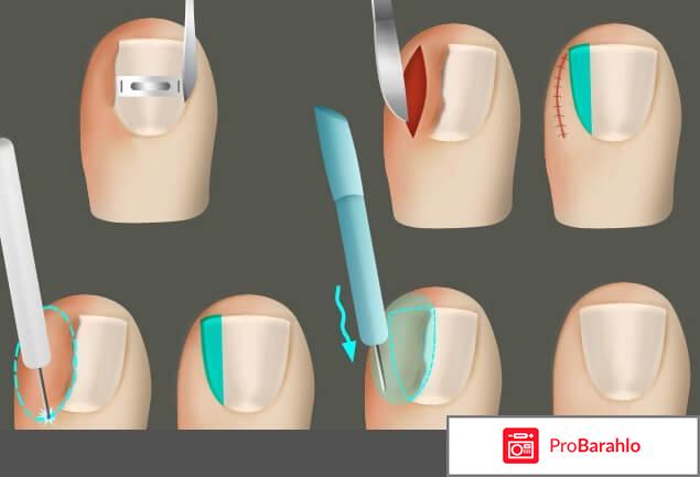 Вросшие ногти на ногах обман