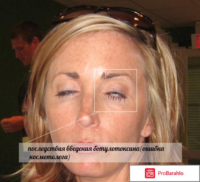 Диспорт фото до и после фото