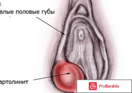 Фурункулы на интимных местах отрицательные отзывы