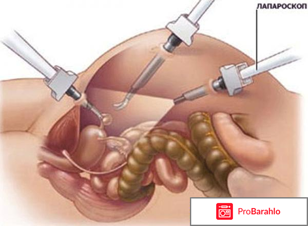 Лапароскопия желчного пузыря отзывы после операции отрицательные отзывы
