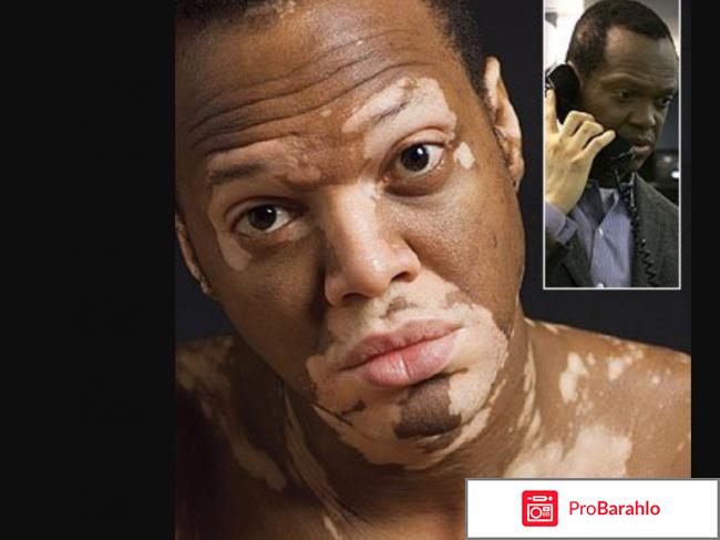 От витилиго sorig отрицательные отзывы