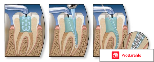 Внутриканальное отбеливание зубов отзывы отрицательные отзывы
