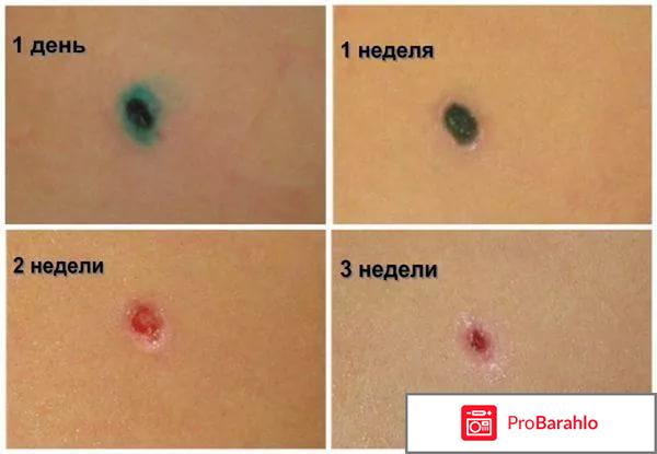 Удаление папиллом жидким азотом последствия 