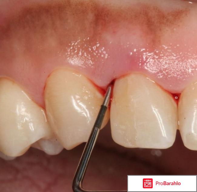 Папиллит что это такое отрицательные отзывы