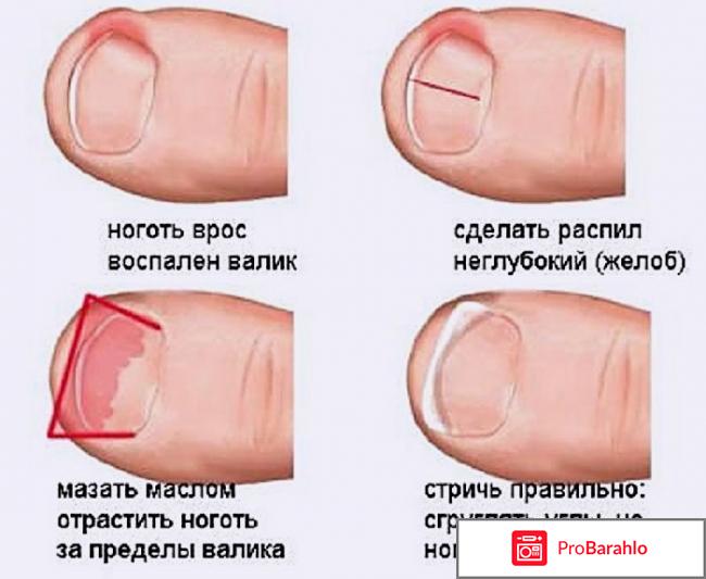 Вросший ноготь на ноге обман