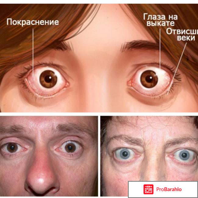 Противопоказания при гипертиреозе обман