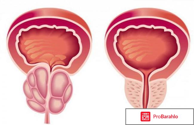 Аводарт кто лечился 