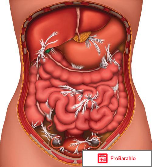 Спайки кишечника: симптомы и лечение 