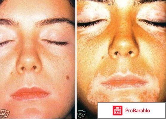 Лечение витилиго отзывы вылечившихся отрицательные отзывы