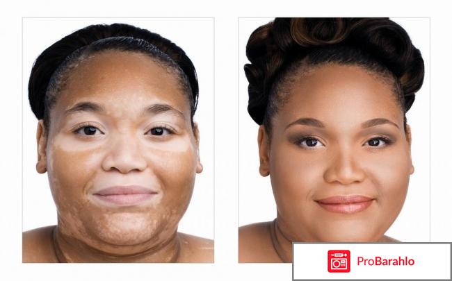 От витилиго sorig обман