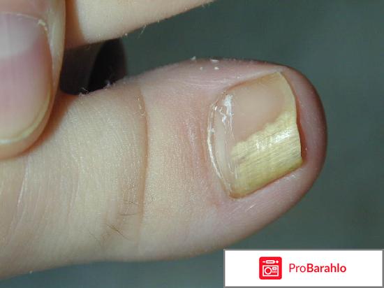 Ламизил Дермгель. 