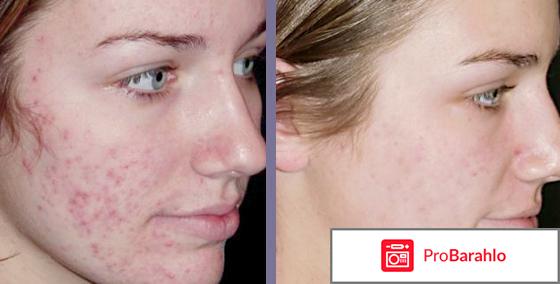 Имофераза отзывы фото отрицательные отзывы