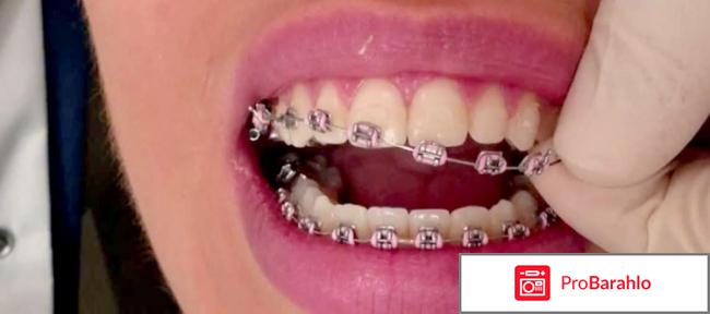 Какие брекеты лучше ставить подростку отзывы 