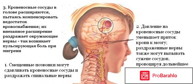 Мигрень симптомы и лечение обман