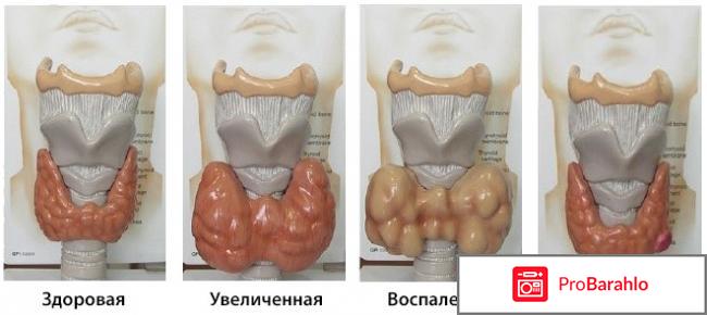 Удаление щитовидной железы отзывы форум обман