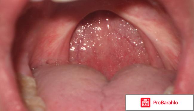 Удаление гланд 