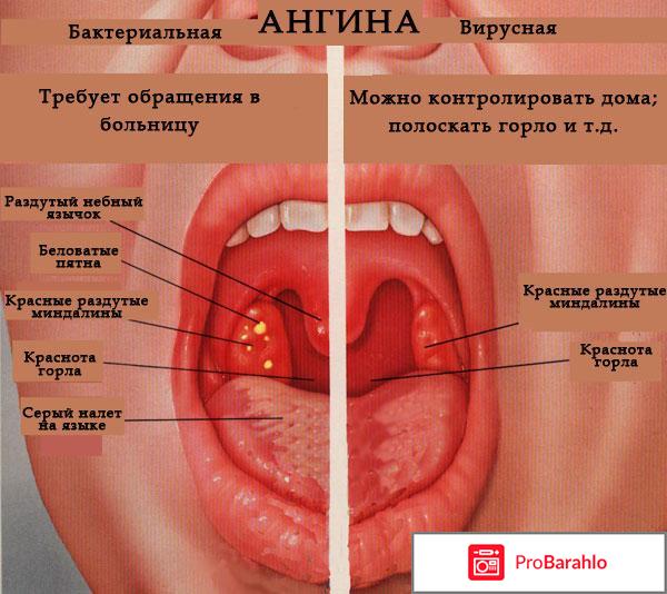 У ребенка красное горло отрицательные отзывы