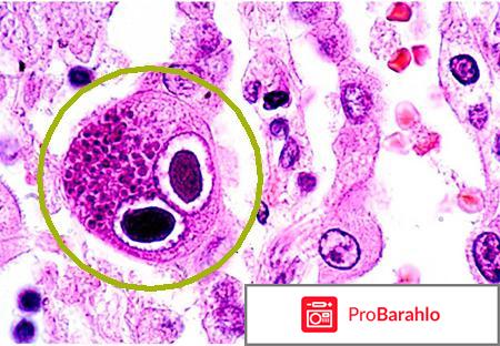 Цитомегаловирусная инфекция симптомы у женщин отзывы отрицательные отзывы