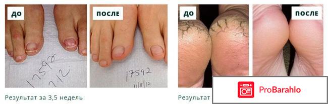 Сангридок от грибка отзывы владельцев