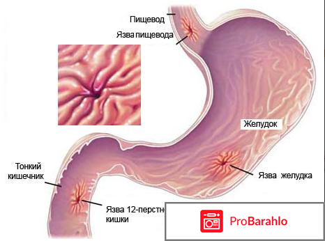 Прополисный Эликсир Здоров от гастрита и язвы 