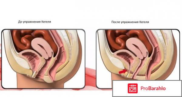 Упражнения кегеля для женщин отзывы отрицательные отзывы