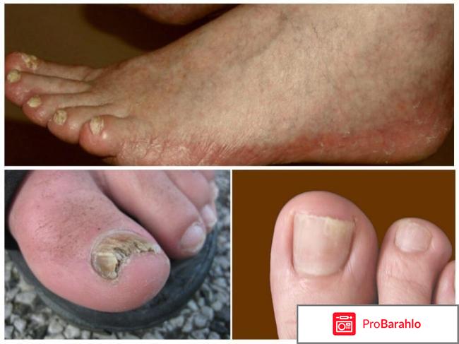 Тербинафин таблетки цена отзывы отрицательные отзывы