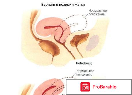 Ретрофлексия матки 