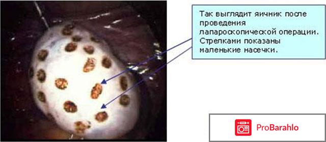 Лапароскопия при поликистозе 