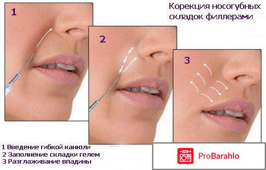 Редженесс филлер отзывы реальные отзывы