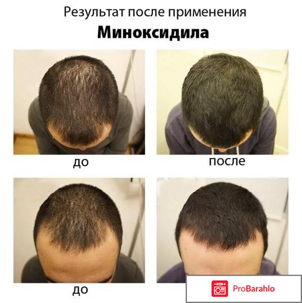 Миноксидил 