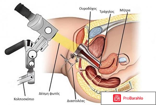 Зачем нужна кольпоскопия шейки матки обман