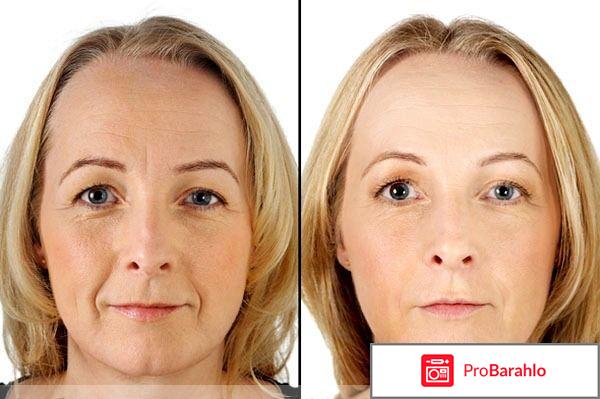 Биовен от морщин цена отзывы где купить обман