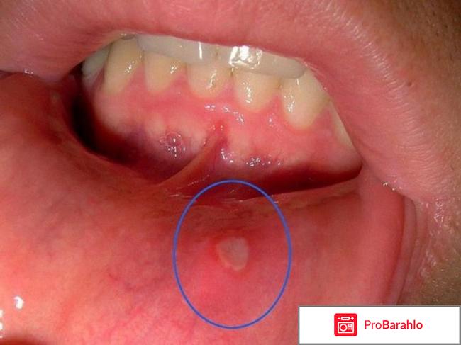 Стоматит лечение в домашних условиях 