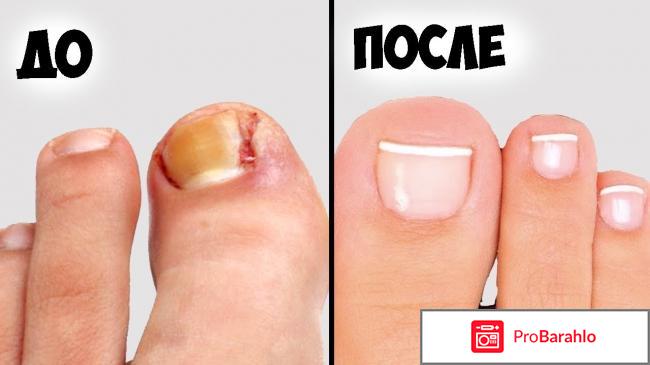 Вросший ноготь на ноге отрицательные отзывы