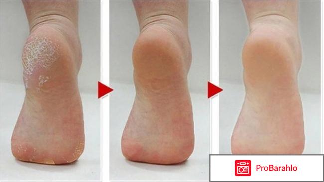 Компресс из уксуса для пяток обман