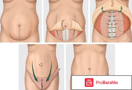 Абдоминопластика отзывы отрицательные отзывы