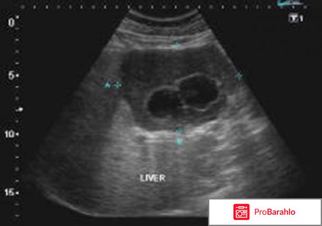 Узи печени показатели отрицательные отзывы