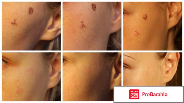 Крем ахромин от пигментных пятен отрицательные отзывы