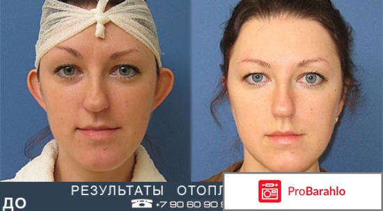 Пластика ушей отрицательные отзывы