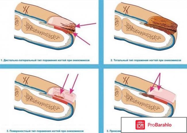 Фламин лак цена отрицательные отзывы