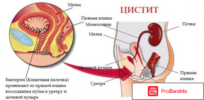 Лучшее лекарство от цистита у женщин отзывы 