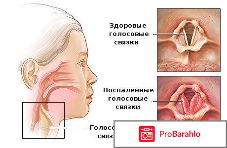 Лечение ларингита 