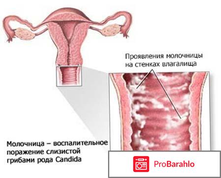 Клотримазол свечи отзывы при молочнице у женщин обман