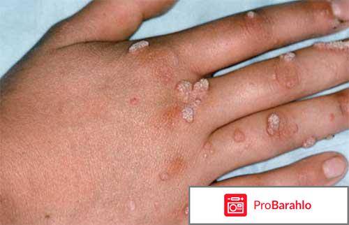 Вирус папилломы человека лечение отзывы 