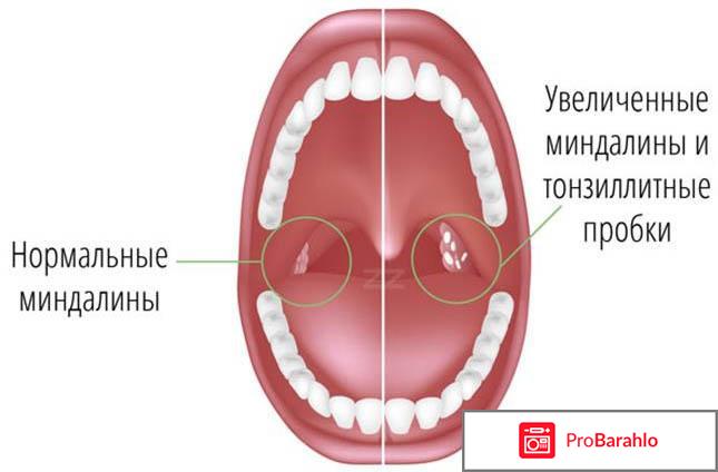 Острый тонзиллит: виды, симптомы, лечение, осложнения отрицательные отзывы